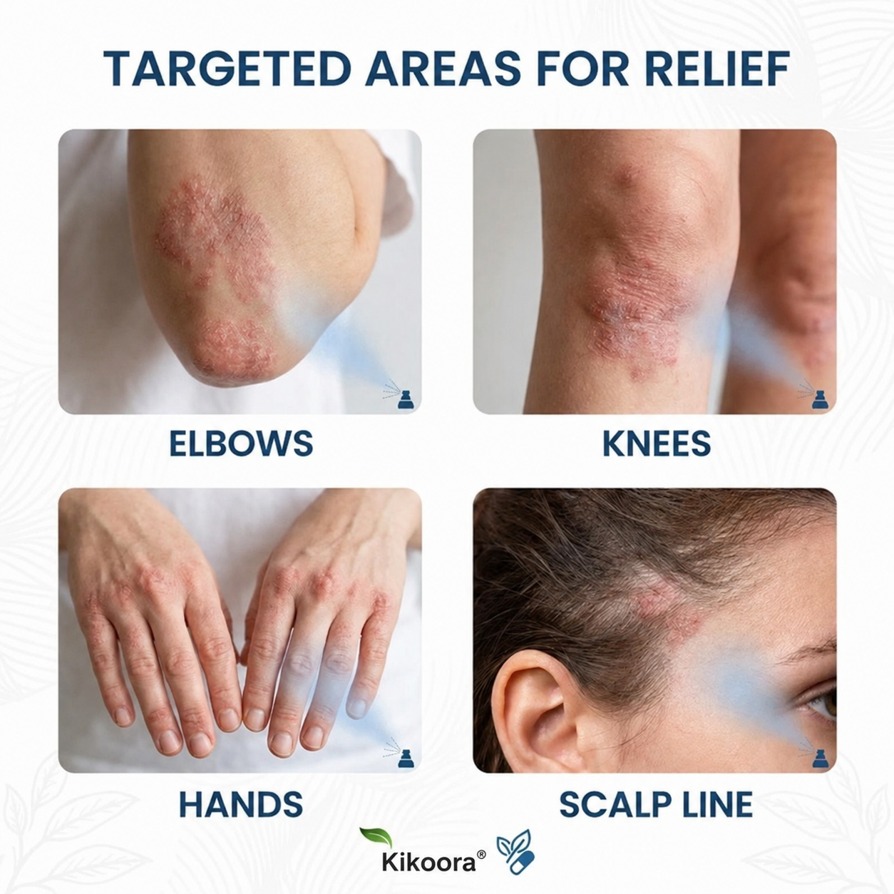 ✨Kikoora® Magnesium Botanical Spray –  Advanced Skin Recovery for Psoriasis & Eczema | Rapid Soothing, Steroid-Free