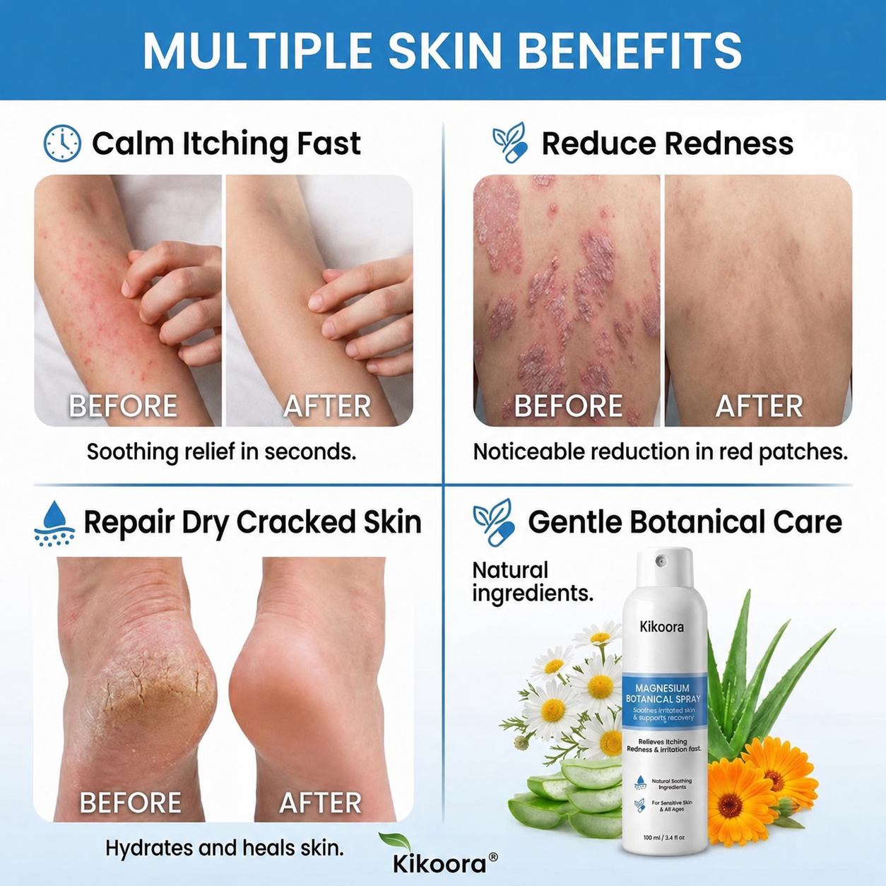 ✨Kikoora® Magnesium Botanical Spray –  Advanced Skin Recovery for Psoriasis & Eczema | Rapid Soothing, Steroid-Free