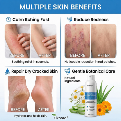 ✨Kikoora® Magnesium Botanical Spray –  Advanced Skin Recovery for Psoriasis & Eczema | Rapid Soothing, Steroid-Free